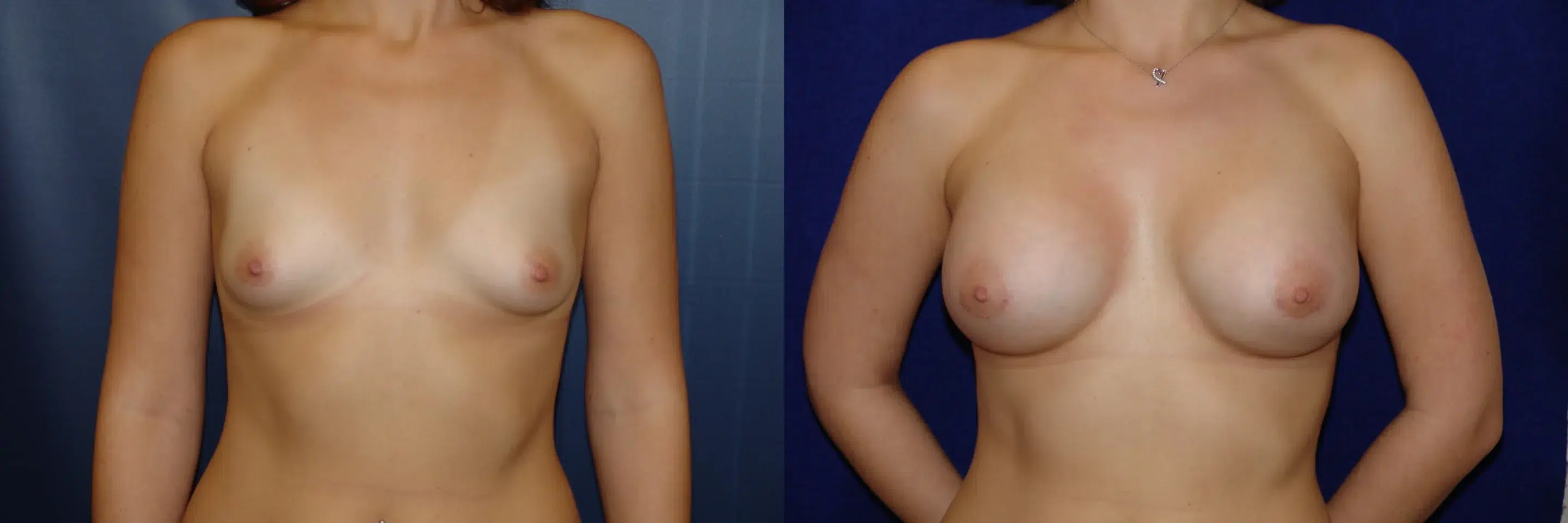 Front View Breast Augmentation Before and After Photo by Dr. Schuster and Dr. Kovacs in Boca Raton