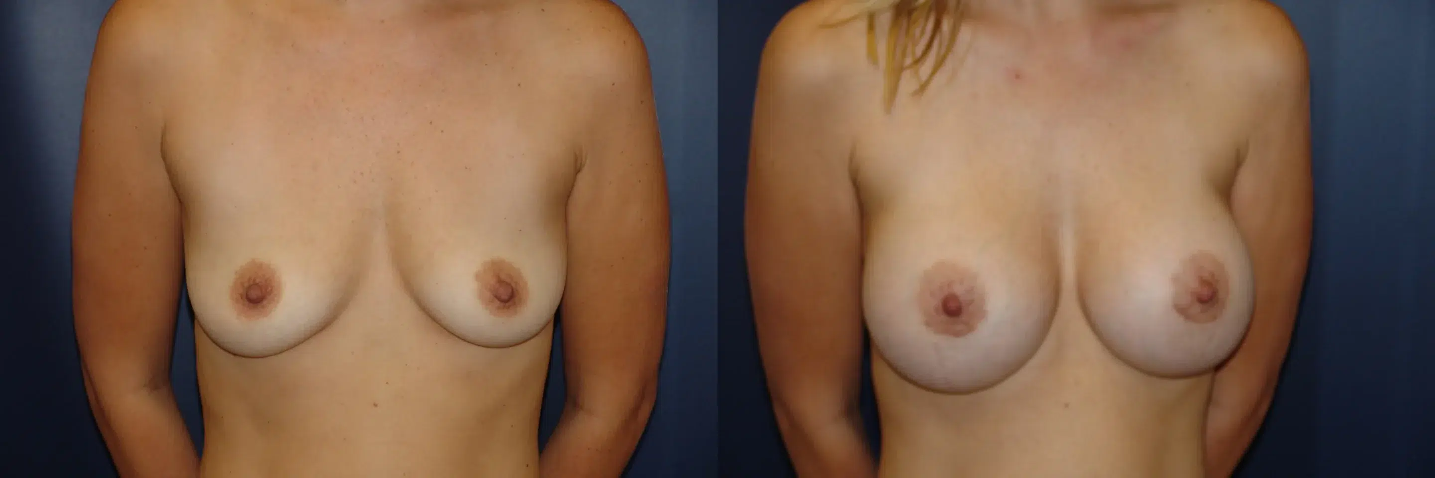 Front View Breast Augmentation Before and After Photo by Dr. Schuster and Dr. Kovacs in Boca Raton