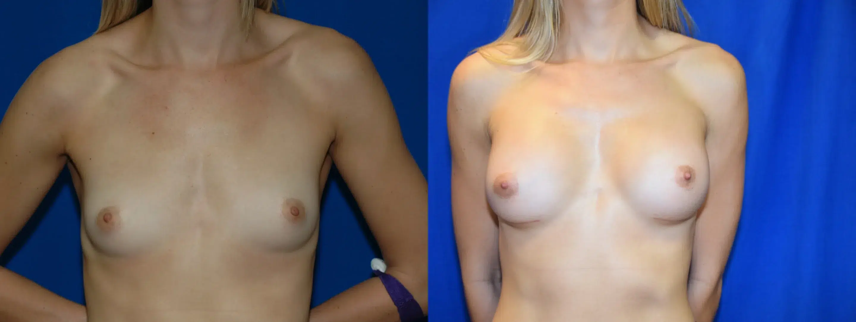 Front View Breast Augmentation Before and After Photo by Dr. Schuster and Dr. Kovacs in Boca Raton