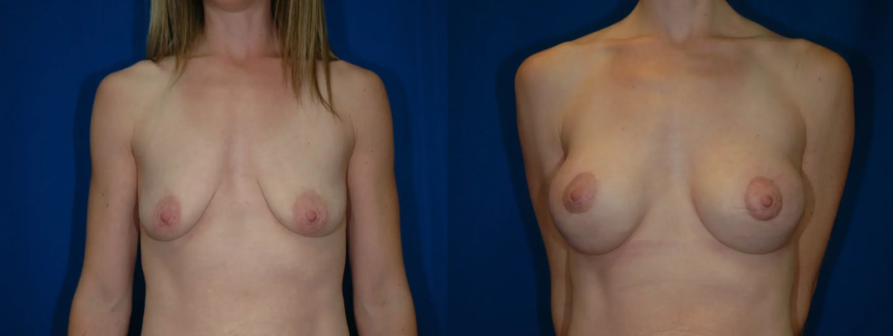 Front View Breast Augmentation Mastopexy Before and After Photo by Dr. Schuster and Dr. Kovacs in Boca Raton