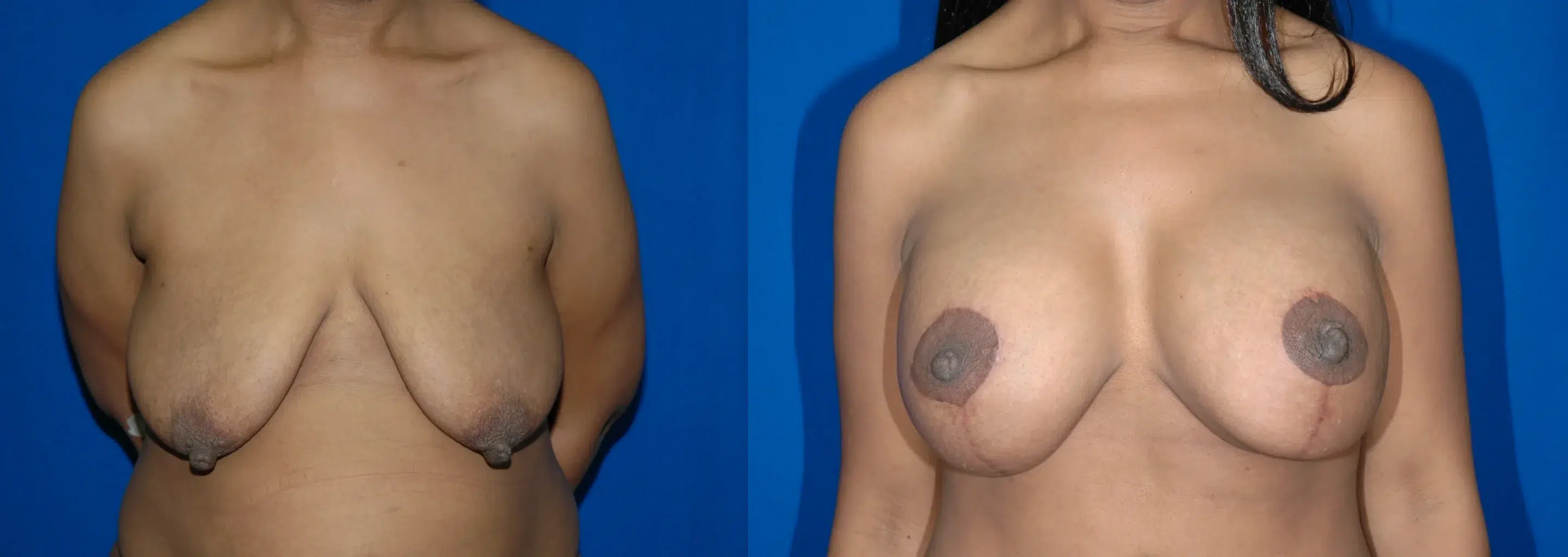 Front View Breast Augmentation Mastopexy Before and After Photo by Dr. Schuster and Dr. Kovacs in Boca Raton