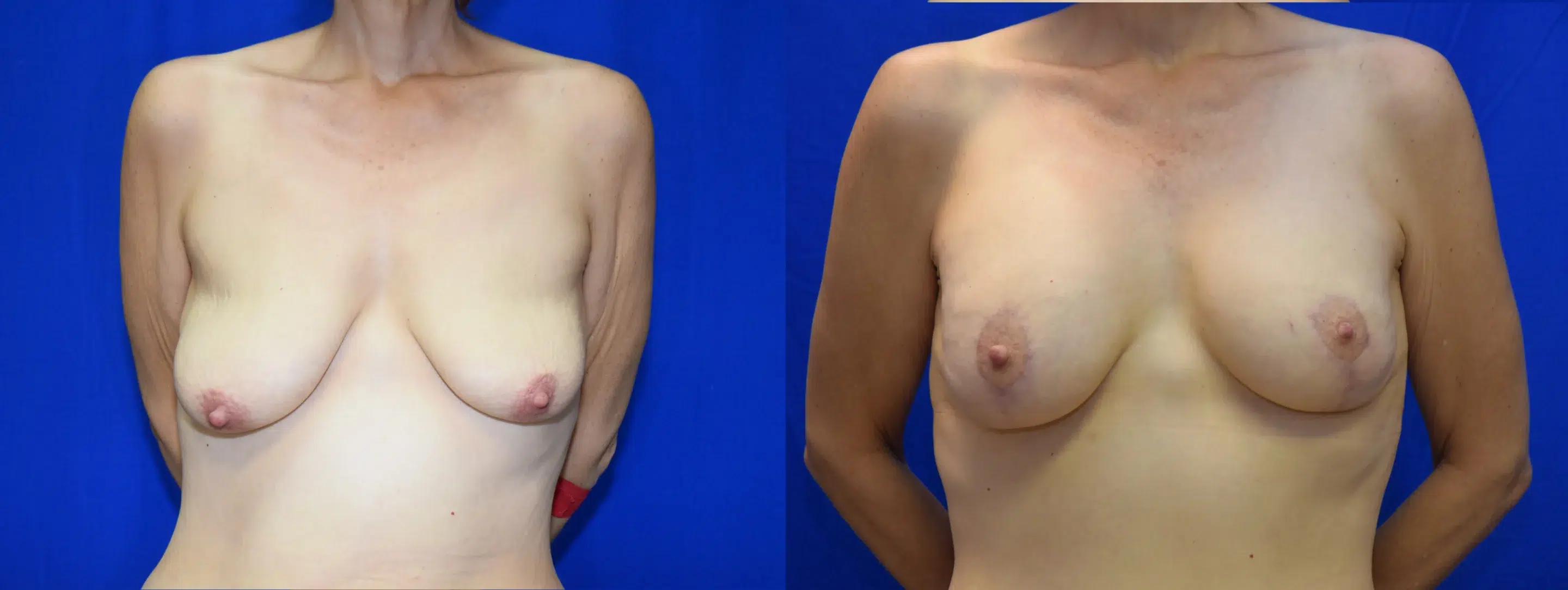 Front View Breast Augmentation Mastopexy Before and After Photo by Dr. Schuster and Dr. Kovacs in Boca Raton