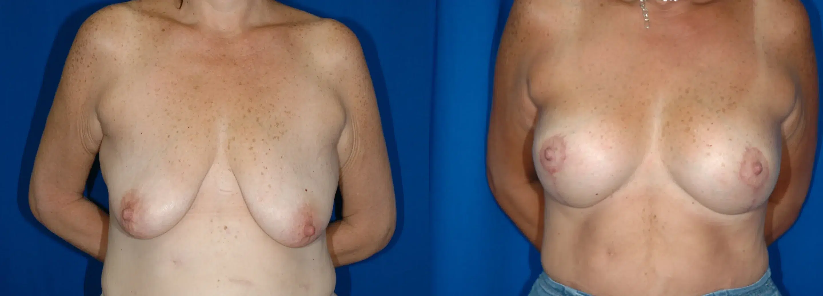 Front View Breast Augmentation Mastopexy Before and After Photo by Dr. Schuster and Dr. Kovacs in Boca Raton