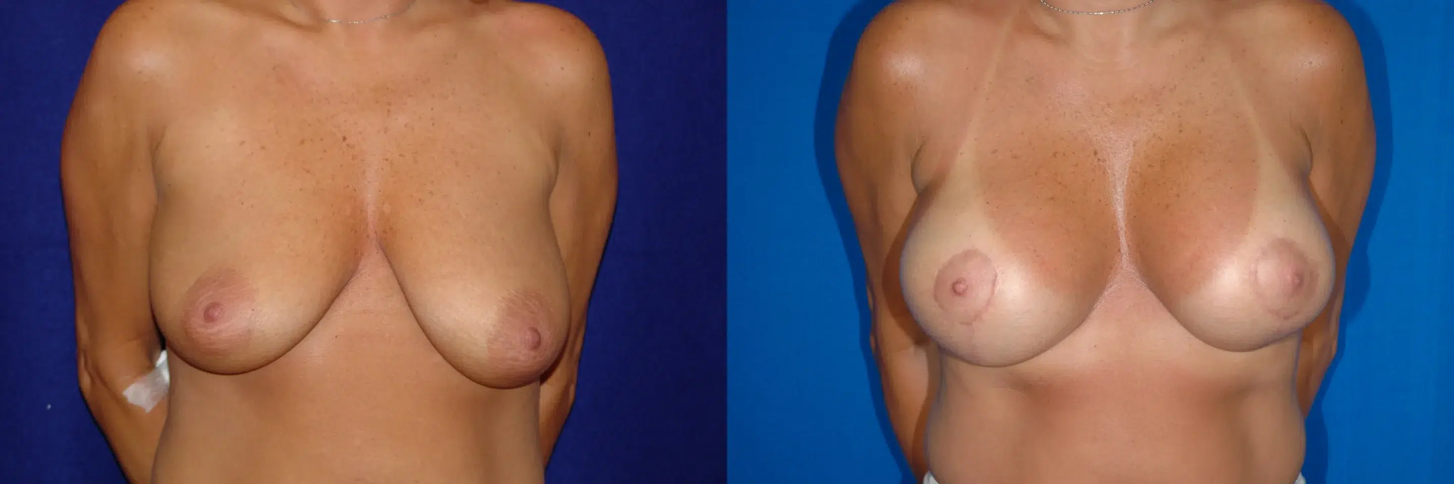 Front View Breast Augmentation Mastopexy Before and After Photo by Dr. Schuster and Dr. Kovacs in Boca Raton