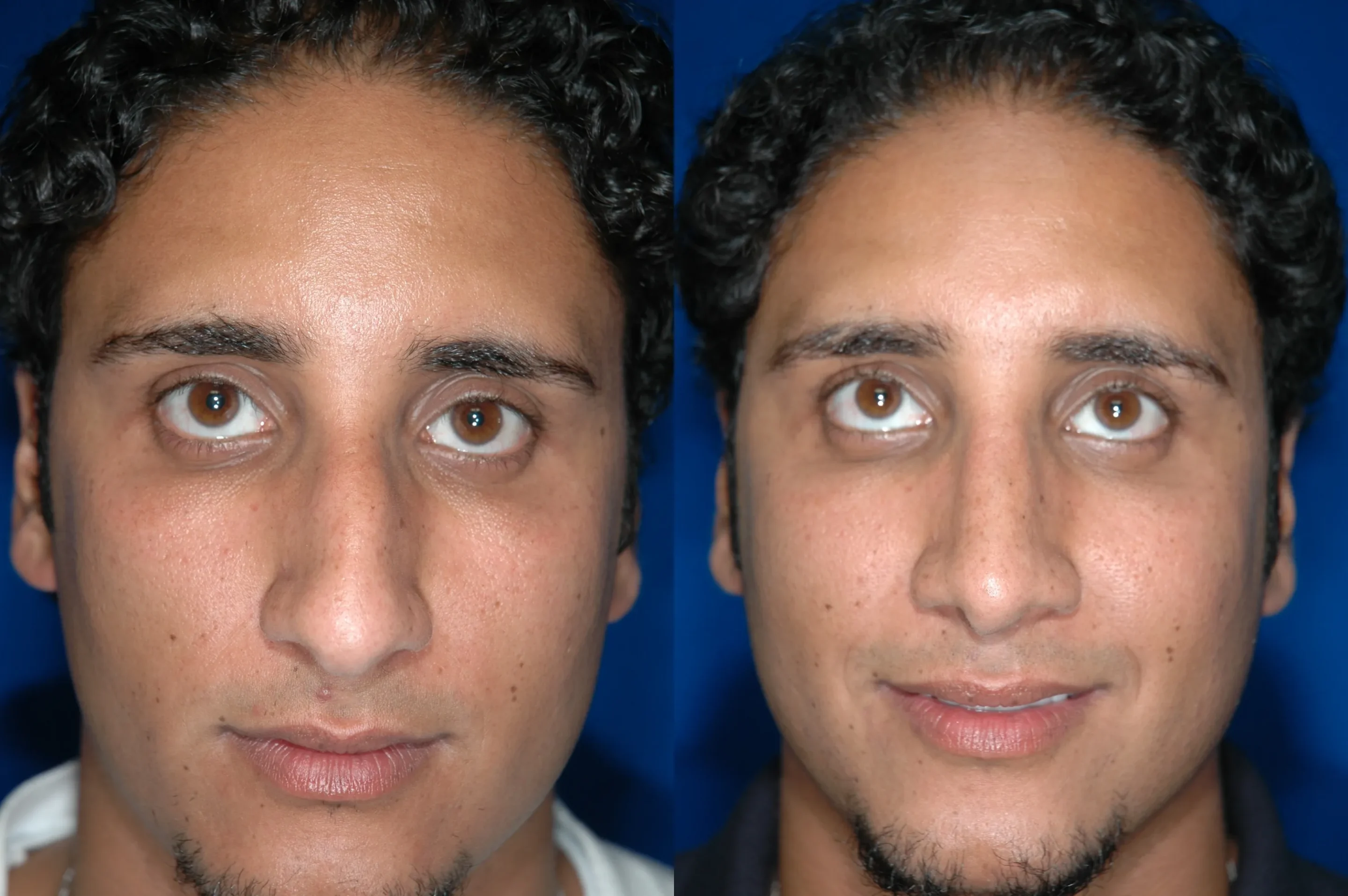 Front View Rhinoplasty Before and After Photo by Dr. Schuster and Dr. Kovacs in Boca Raton