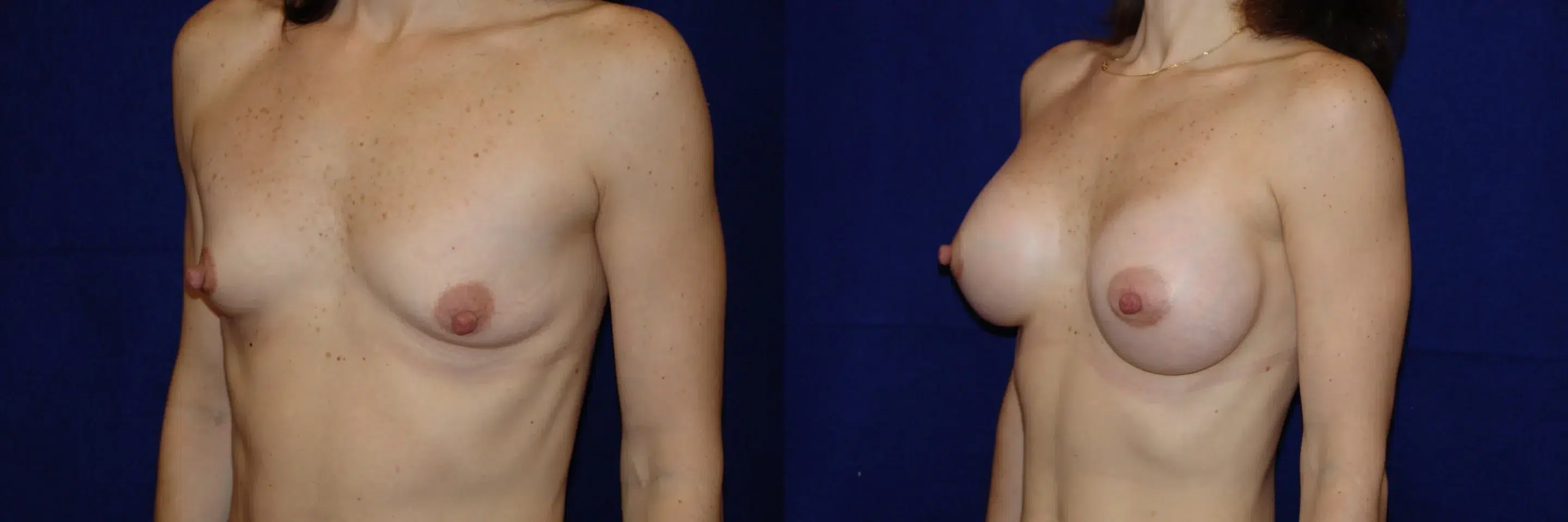 Left Oblique View Breast Augmentation Before and After Photo by Dr. Schuster and Dr. Kovacs in Boca Raton