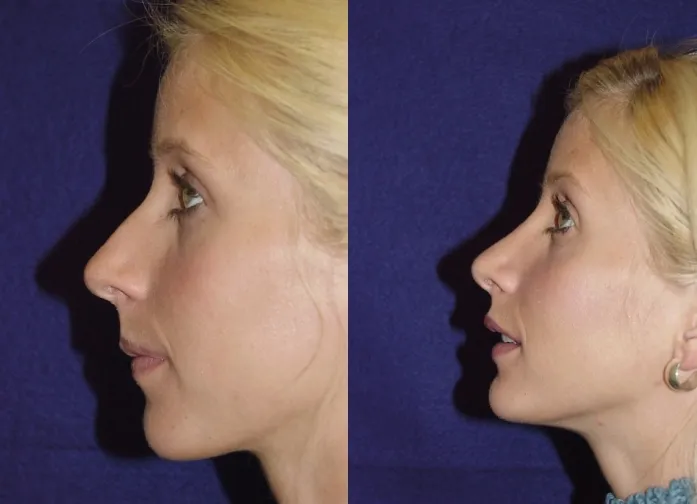 Left Side View Rhinoplasty Before and After Photo by Dr. Schuster and Dr. Kovacs in Boca Raton