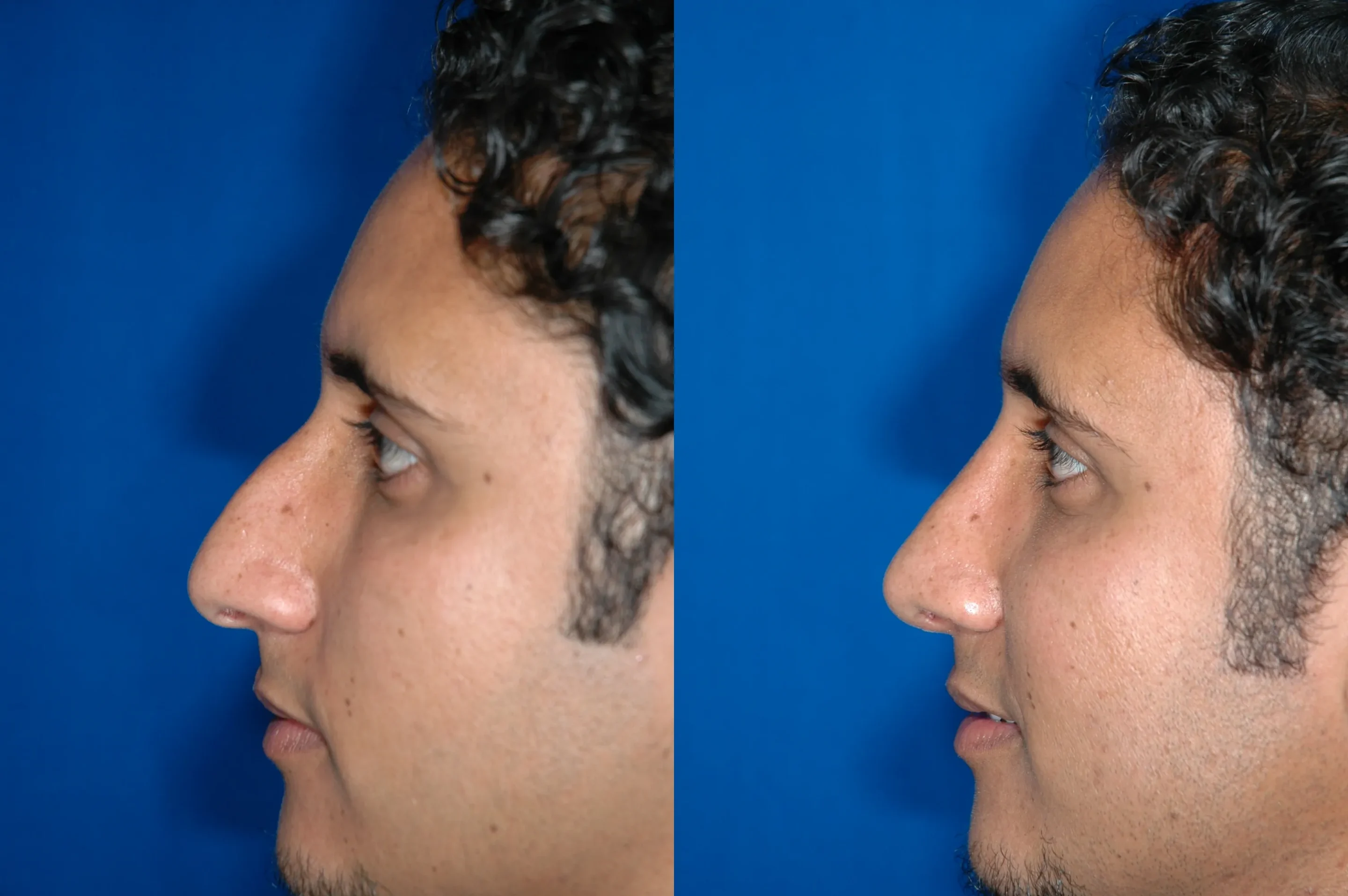 Left Side View Rhinoplasty Before and After Photo by Dr. Schuster and Dr. Kovacs in Boca Raton Left Side View Rhinoplasty Before and After Photo by Dr. Schuster and Dr. Kovacs in Boca Raton
