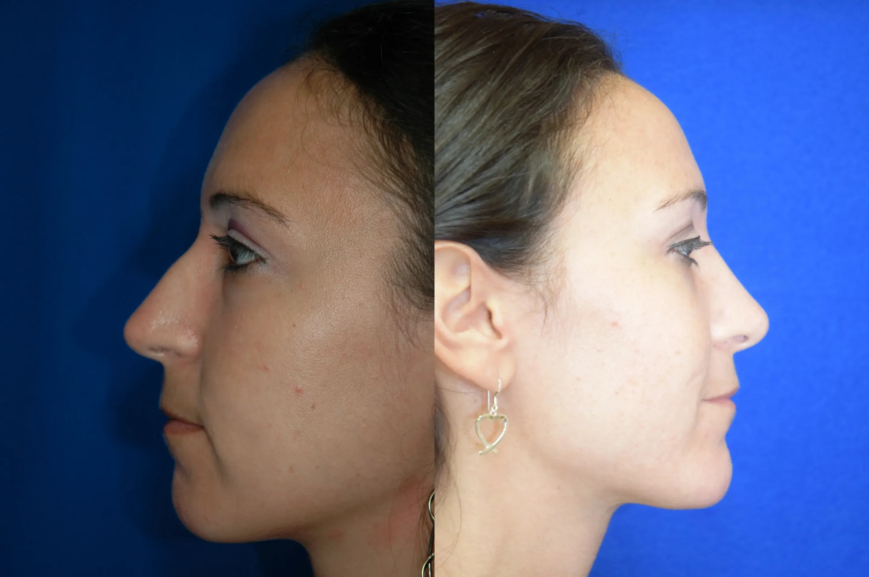 Right Left Side View Rhinoplasty Before and After Photo by Dr. Schuster and Dr. Kovacs in Boca Raton