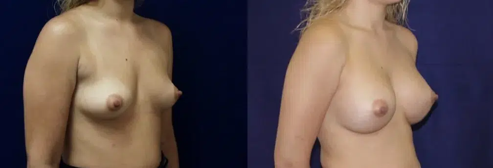 Right Oblique View Breast Augmentation Before and After Photo by Dr. Schuster and Dr. Kovacs in Boca Raton