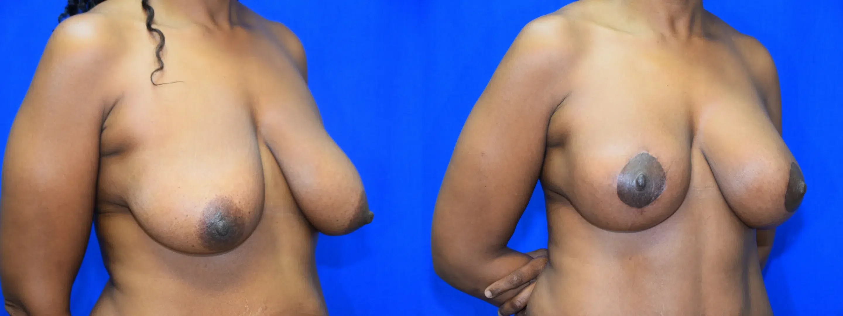 Right Oblique View Breast Augmentation Mastopexy Before and After Photo by Dr. Schuster and Dr. Kovacs in Boca Raton