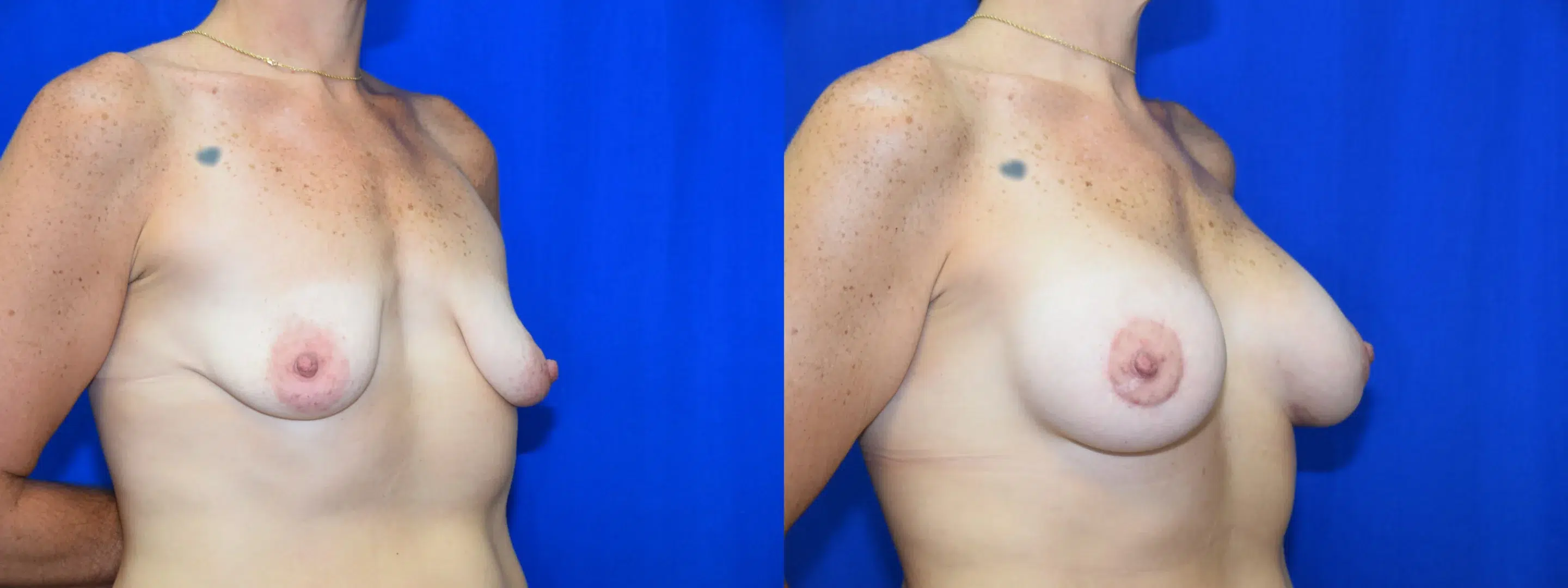 Right Oblique View Breast Augmentation Mastopexy Before and After Photo by Dr. Schuster and Dr. Kovacs in Boca Raton