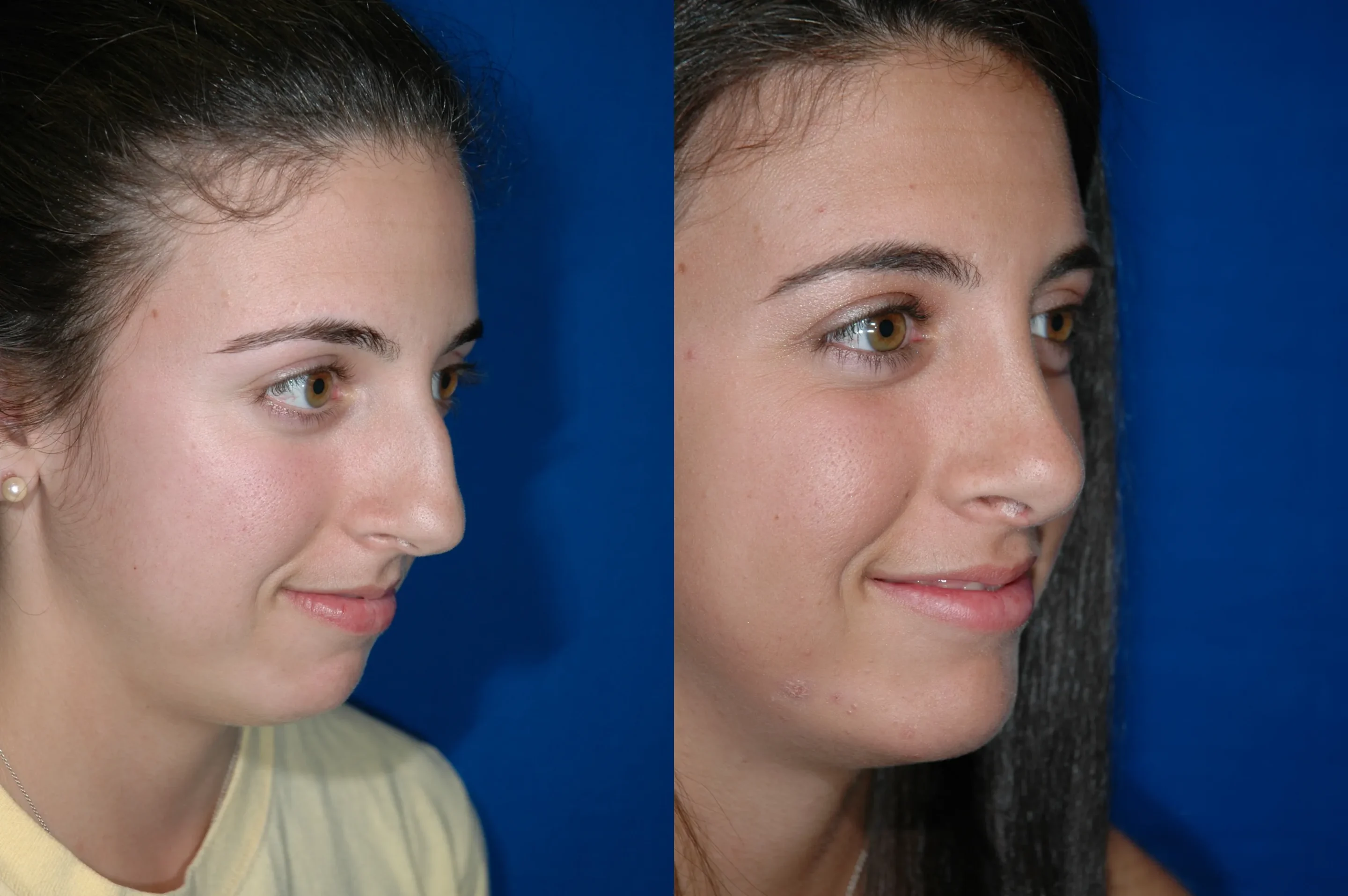 Right Oblique View Rhinoplasty Before and After Photo by Dr. Schuster and Dr. Kovacs in Boca Raton Right Oblique View Rhinoplasty Before and After Photo by Dr. Schuster and Dr. Kovacs in Boca Raton
