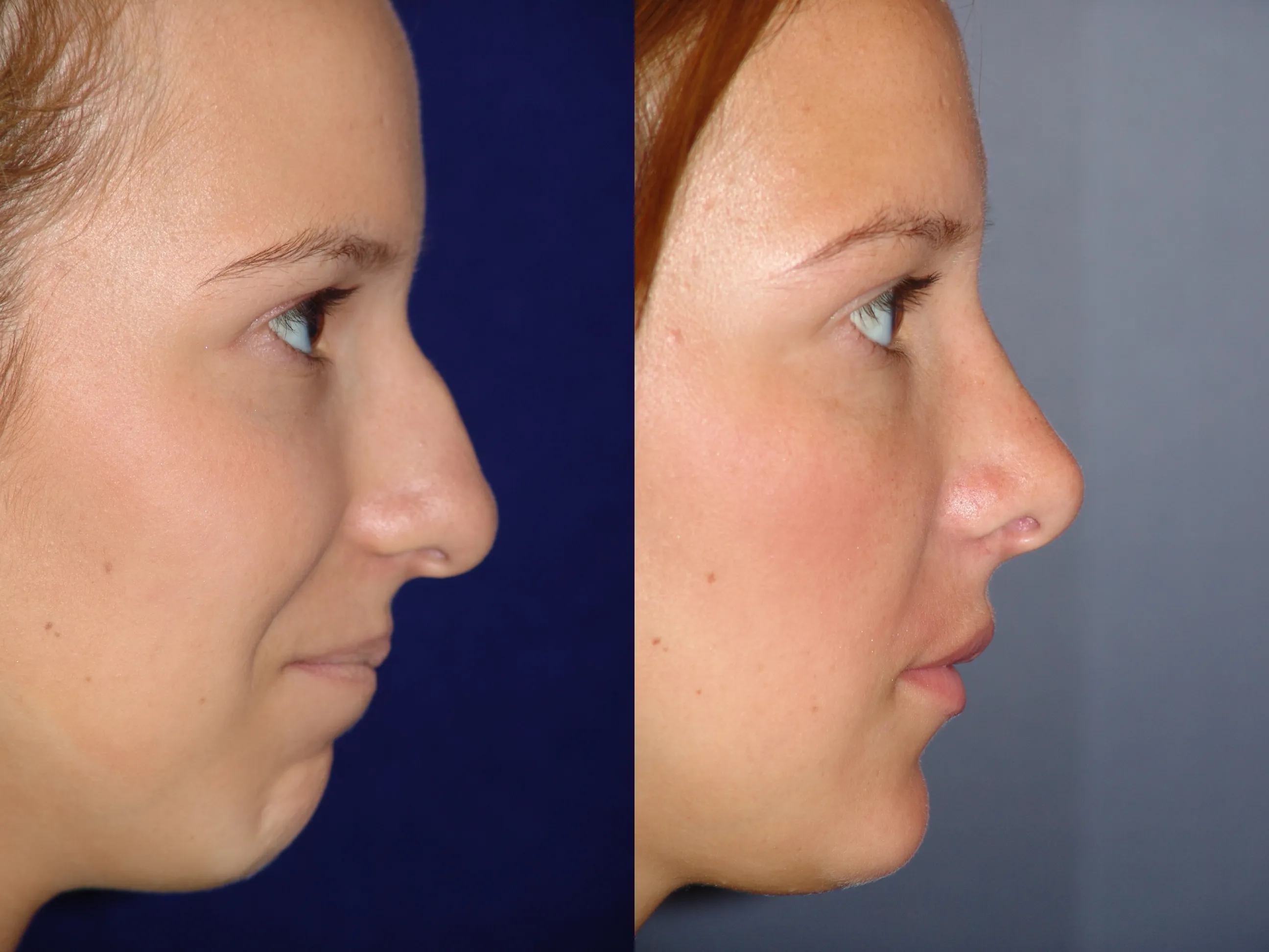 Right Side View Rhinoplasty Before and After Photo by Dr. Schuster and Dr. Kovacs in Boca Raton
