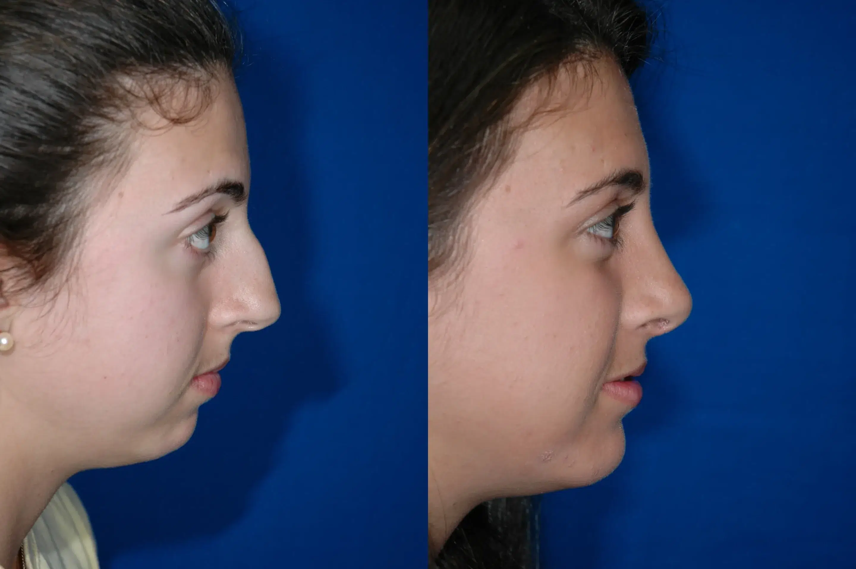 Right Side View Rhinoplasty Before and After Photo by Dr. Schuster and Dr. Kovacs in Boca Raton