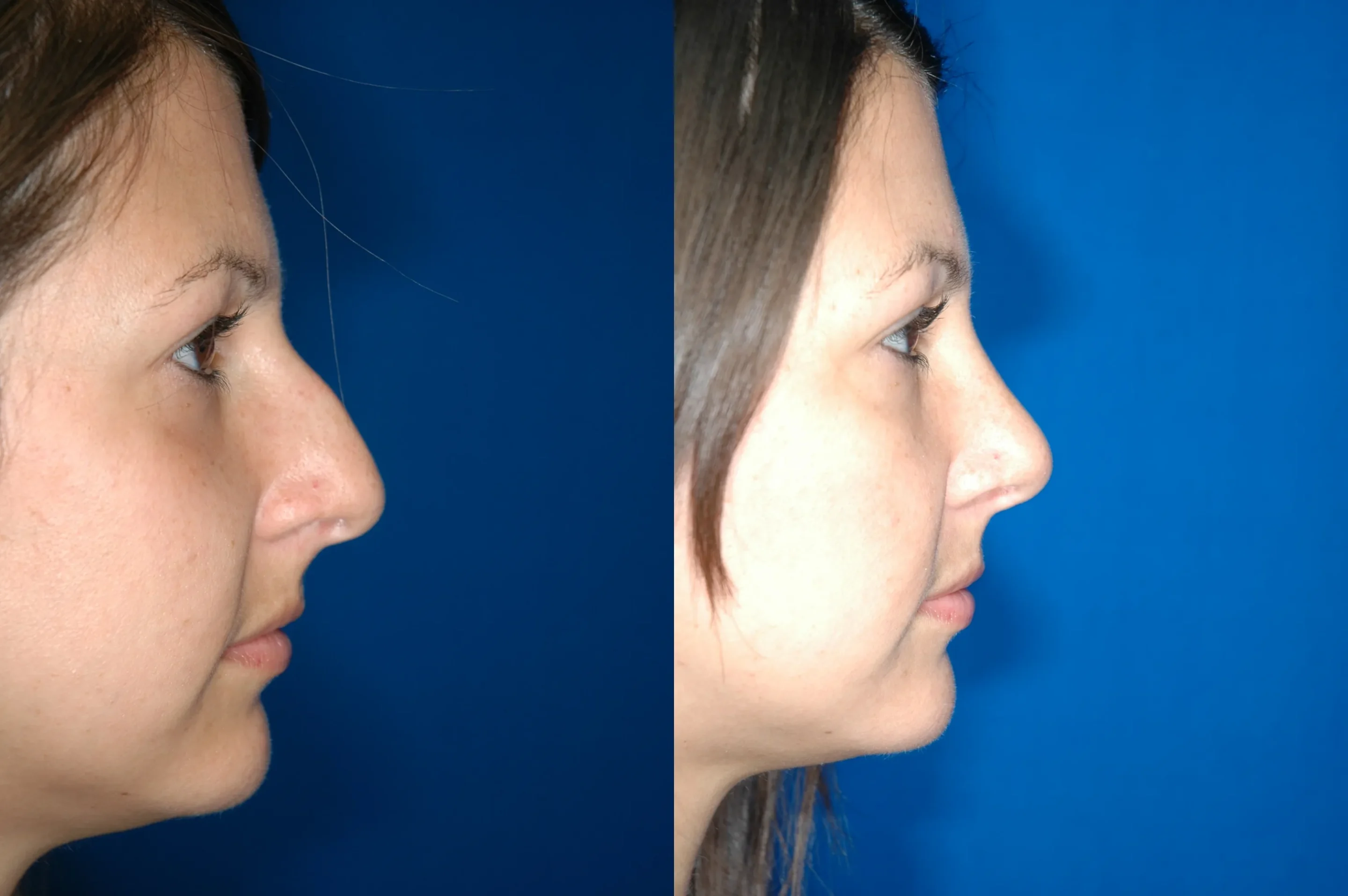 Right Side View Rhinoplasty Before and After Photo by Dr. Schuster and Dr. Kovacs in Boca Raton