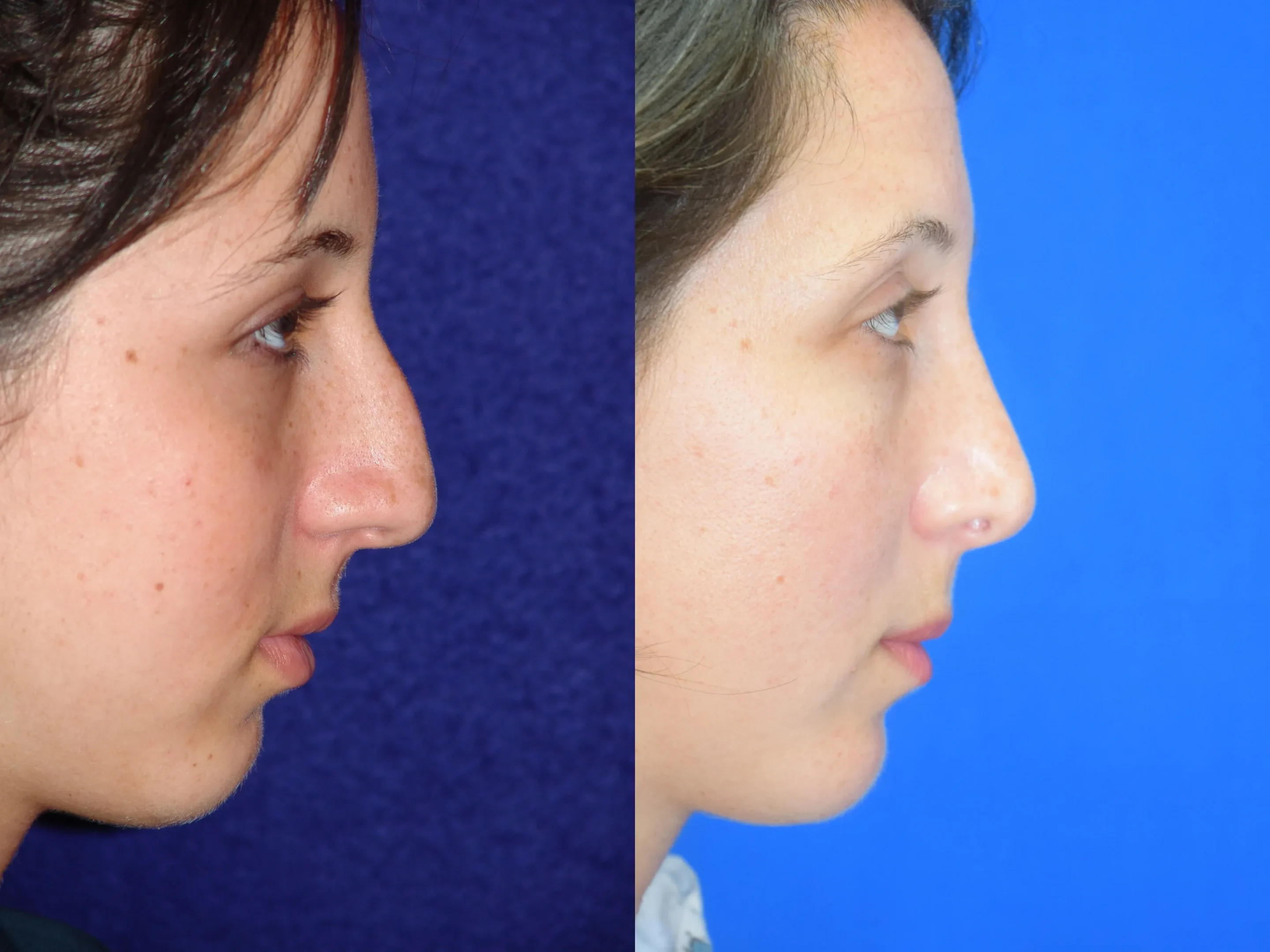 Right Side View Rhinoplasty Before and After Photo by Dr. Schuster and Dr. Kovacs in Boca Raton