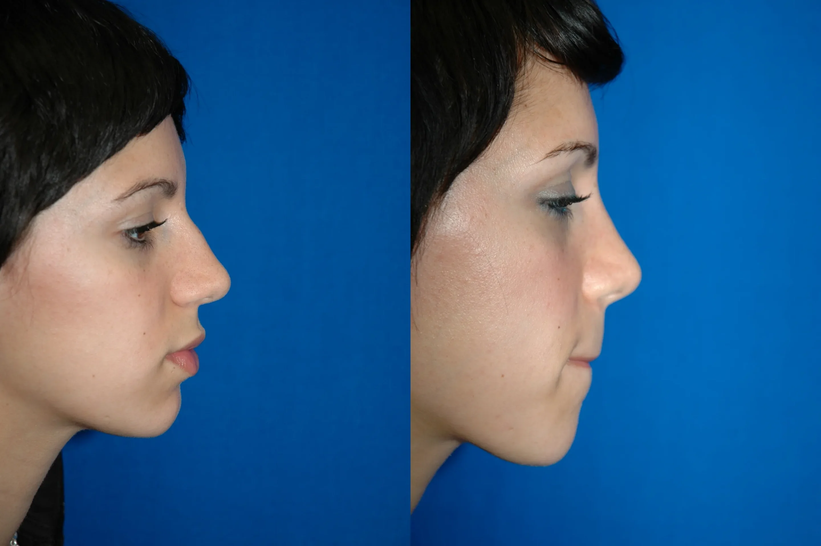 Right Side View Rhinoplasty Before and After Photo by Dr. Schuster and Dr. Kovacs in Boca Raton