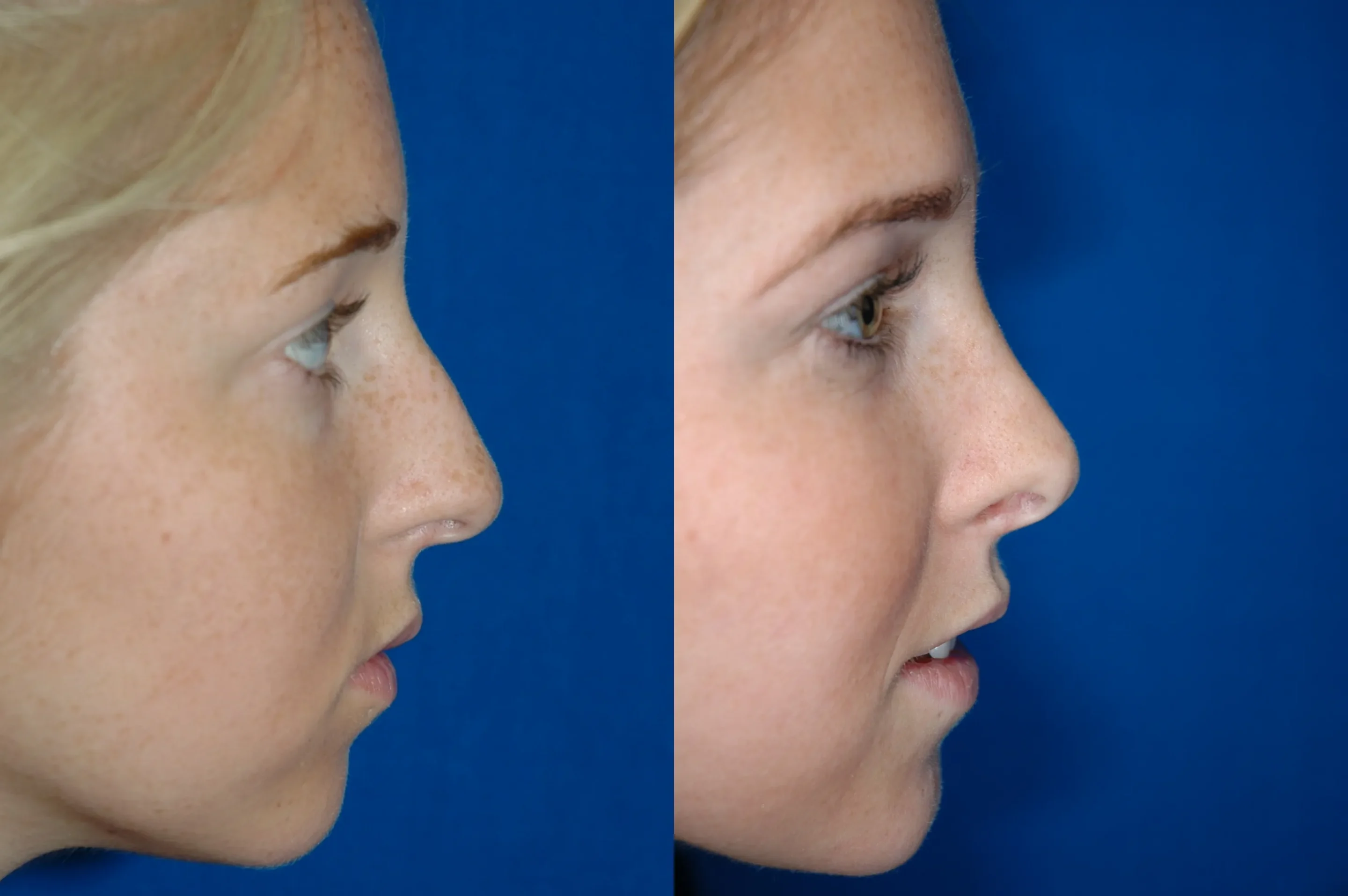 Right Side View Rhinoplasty Before and After Photo by Dr. Schuster and Dr. Kovacs in Boca Raton
