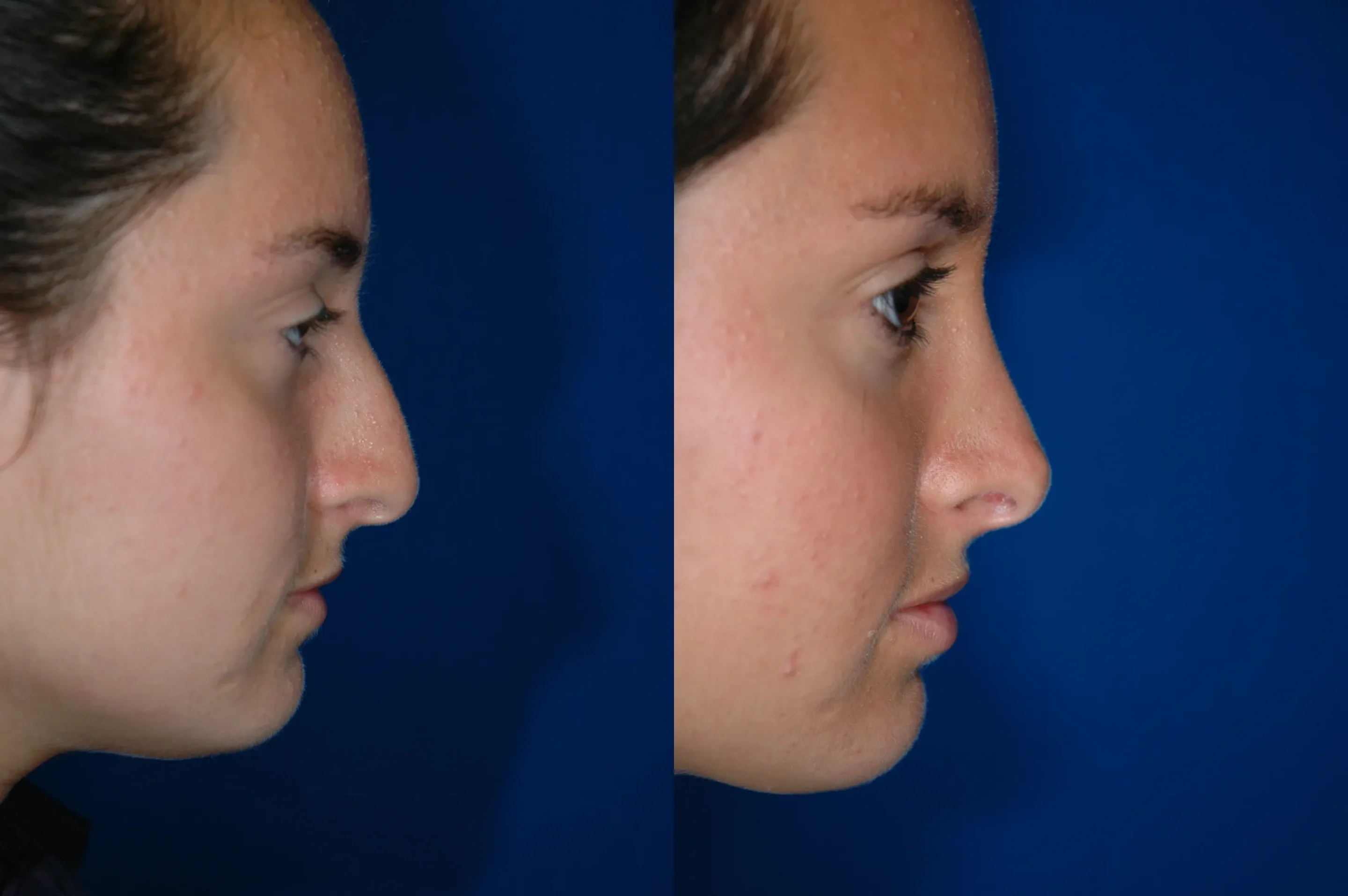Right Side View Rhinoplasty Before and After Photo by Dr. Schuster and Dr. Kovacs in Boca Raton