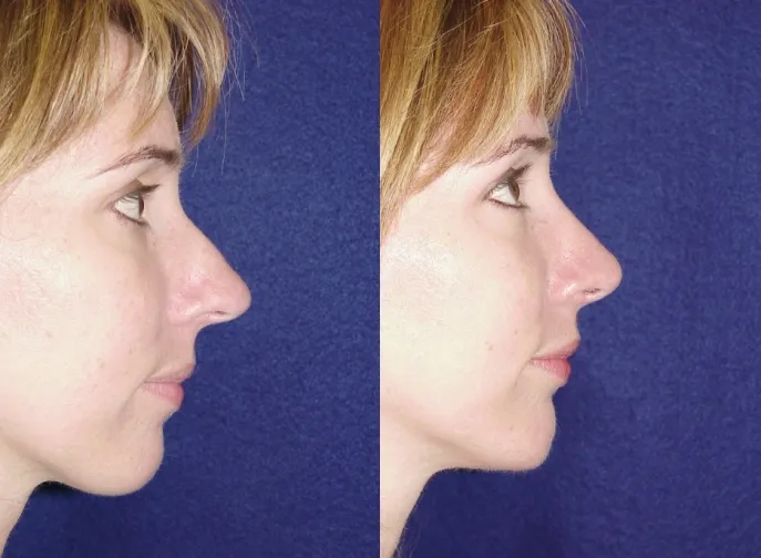 Right Side View Rhinoplasty Before and After Photo by Dr. Schuster and Dr. Kovacs in Boca Raton